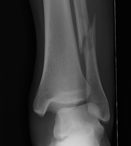Ankle Weber C Fracture